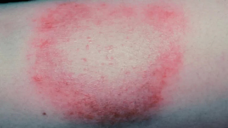 Lyme hastalığı